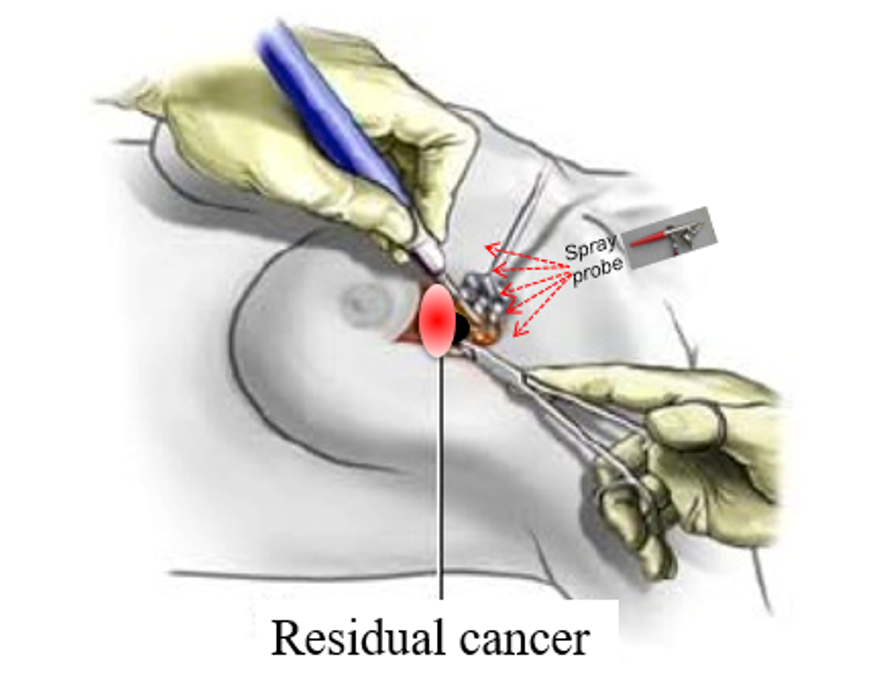 Akrotome-residual cancer